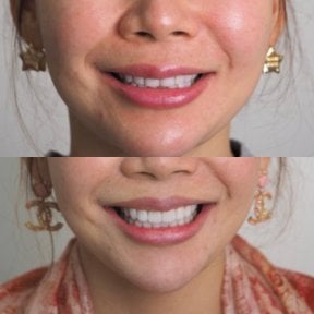Before and after veneers result at Dentist at home Clinic, Chonburi – smile transformation