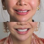 Before and after veneers result at Dentist at home Clinic, Chonburi – smile transformation