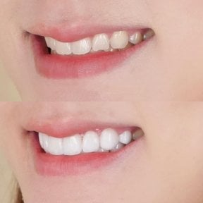 Before and after veneers result at Dentist at home Clinic, Chonburi – smile transformation