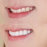 Before and after veneers result at Dentist at home Clinic, Chonburi – smile transformation