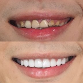 Before and after veneers result at Dentist at home Clinic, Chonburi – smile transformation