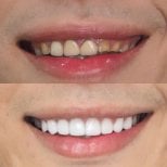 Before and after veneers result at Dentist at home Clinic, Chonburi – smile transformation