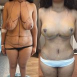Before and after breast implants with breast lift results at Memorial Bahçelievler Hospital