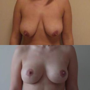 Before and after breast implants with lift results at Memorial Bahçelievler Hospital