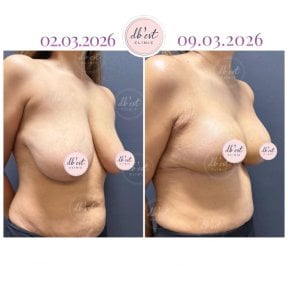 before-after photo umensenie-grudi
