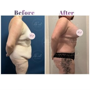 before-after photo krugovaa-podtazka-tela