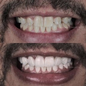 Résultats avant/après facettes composites – sourire amélioré et dents plus blanches