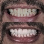 Résultats avant/après facettes composites – sourire amélioré et dents plus blanches