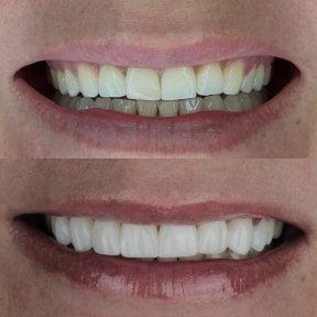 Résultats avant/après facettes composites – sourire plus blanc et uniforme