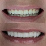 Résultats avant/après facettes composites – sourire plus blanc et uniforme