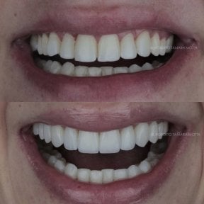 Résultats avant/après facettes en porcelaine – sourire par Dr Roberto Támara Motta
