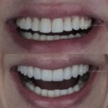 Résultats avant/après facettes en porcelaine – sourire par Dr Roberto Támara Motta