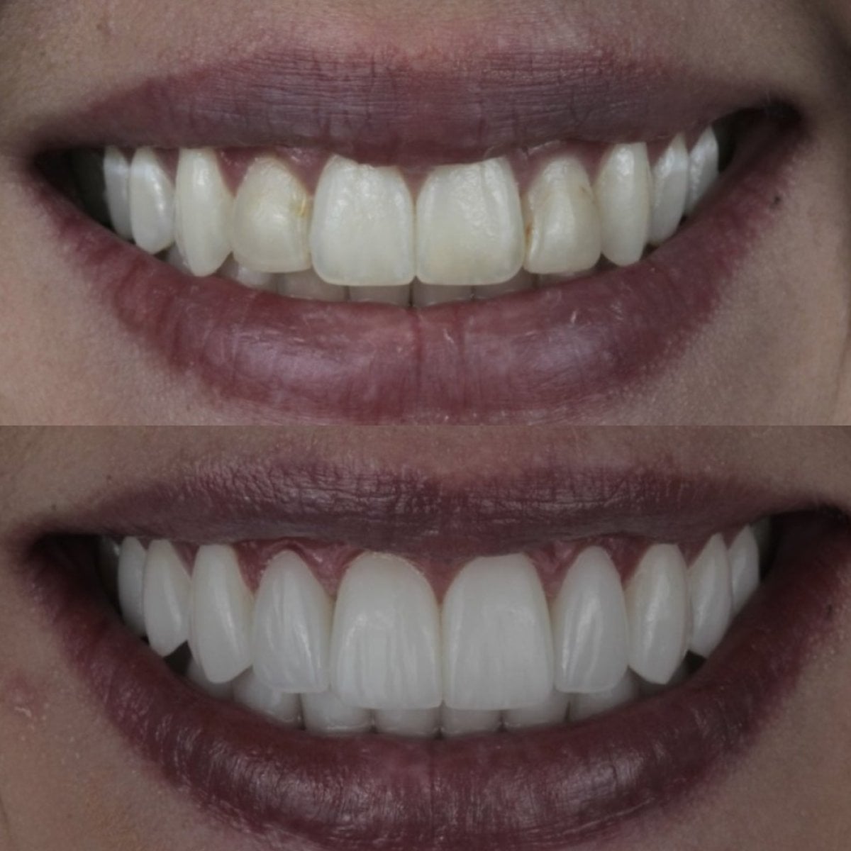 Resultados antes y después de carillas de porcelana: sonrisa mejorada y dientes más blancos