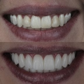 Résultats avant et après facettes en porcelaine – sourire amélioré et dents plus blanches