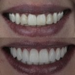 Résultats avant et après facettes en porcelaine – sourire amélioré et dents plus blanches