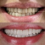 Résultats avant/après smile makeover – dents plus blanches et régulières après facettes