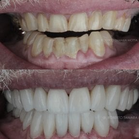 Résultats avant/après smile makeover – facettes dentaires pour dents blanches et alignées