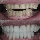 Résultats avant/après smile makeover – facettes dentaires pour dents blanches et alignées