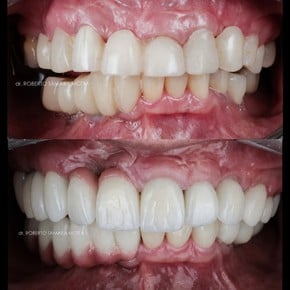 Résultats avant/après smile makeover avec facettes dentaires – alignement et couleur améliorés