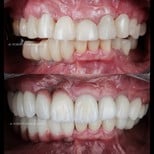 Résultats avant/après smile makeover avec facettes dentaires – alignement et couleur améliorés