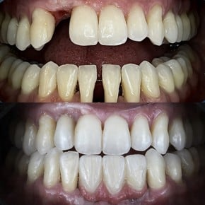 Résultats avant/après implant dentaire avec couronne – dent restaurée, sourire amélioré