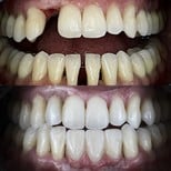Résultats avant/après implant dentaire avec couronne – dent restaurée, sourire amélioré