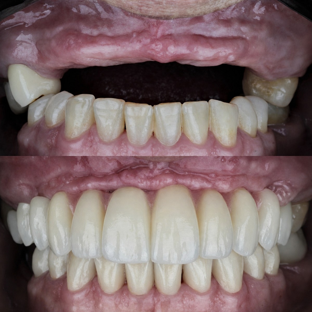 Resultados antes y después de implantes dentales All-on-6 – restauración total de la sonrisa