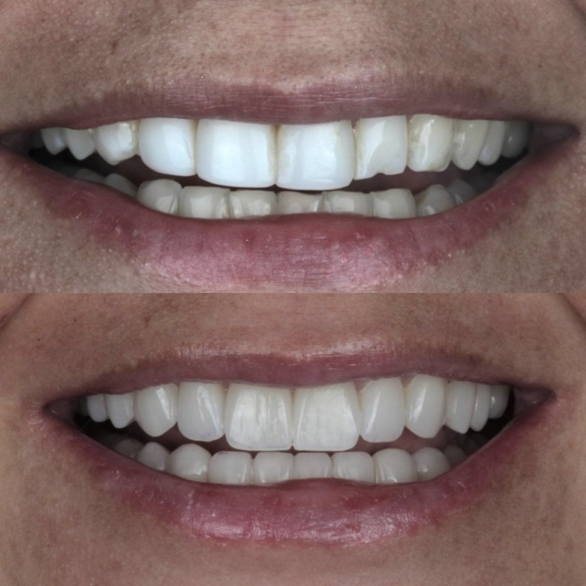 Resultados antes y después de carillas de porcelana: sonrisa mejorada y dientes más blancos
