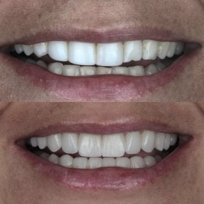 Résultats avant et après facettes en porcelaine – sourire amélioré et dents plus blanches