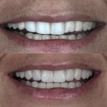 Résultats avant et après facettes en porcelaine – sourire amélioré et dents plus blanches