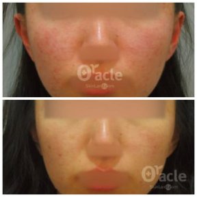 before-after photo termaz