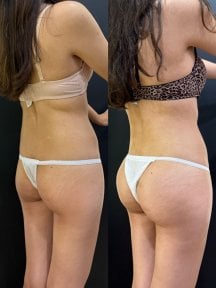 before-after photo breast-augmentation
