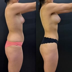 before-after photo breast-augmentation