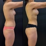 Before and after butt implants at Dr. Alexandro Aguilera - Plastic Surgery, enhanced curves result