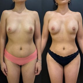 Before and after butt implants at Dr. Alexandro Aguilera - Plastic Surgery, enhanced curves result