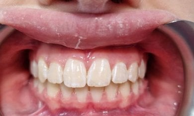 before-after photo braces
