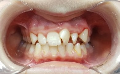 before-after photo braces