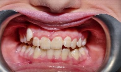 before-after photo braces