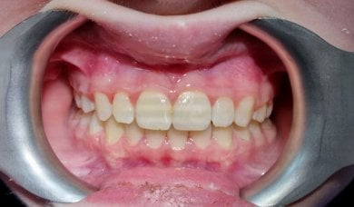 before-after photo braces