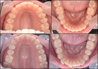 before-after photo breket-sistema