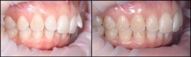 before-after photo breket-sistema