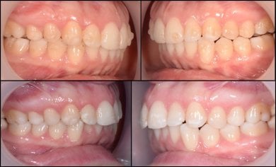 before-after photo breket-sistema
