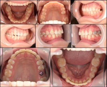before-after photo breket-sistema