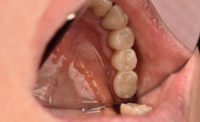 before-after photo denture