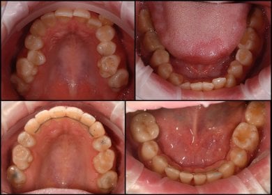 before-after photo breket-sistema