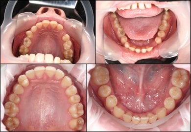 before-after photo breket-sistema