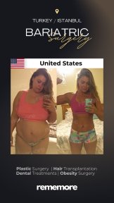 before-after photo roux-en-y-gastric-bypass