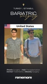 before-after photo roux-en-y-gastric-bypass