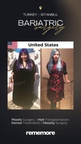 before-after photo roux-en-y-gastric-bypass