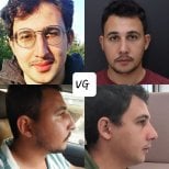 Результати ринопластики до і після у VG Plastic Surgery, покращена форма носа та профіль